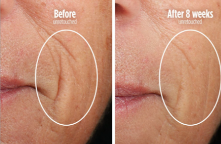 Shark CryoGlow Blemish Repair Mask with Charging Stand - Blue Frost